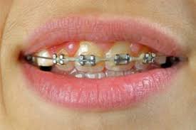 Some of the home remedies to whiten the teeth with braces includes oil pulling, eating strawberries, mixture of baking soda with lemon, flossing the teeth and eating crunchy vegetables and how to clean your teeth with braces? How To Whiten Teeth With Braces Howstuffworks