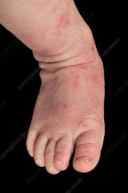 atopic eczema on a baby s foot stock