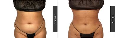 liposuction cost new york how much