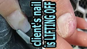onycholysis client s nail is lifting