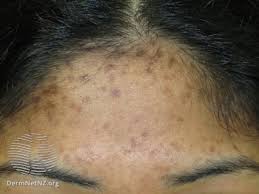 post inflammatory hyperpigmentation and