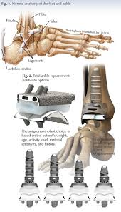 total ankle arthroplasty questions for