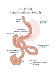 duodenal switch procedures sadi s and