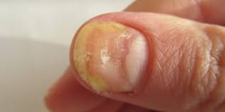 nail disorders san luis obispo ca