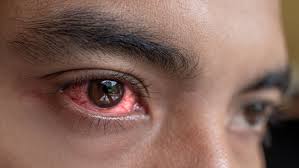 sunburned eyes symptoms prevention tips