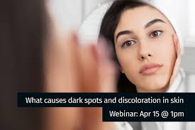 what causes dark spots and