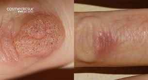Learn about salicylic acid warts removal. Wart Removal London And Bristol Cosmedics Skin Clinics