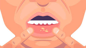 mouth ulcer effective remes and