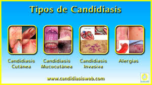 Image result for candidiasis
