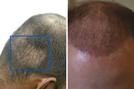 hair transplant after 1 month photos