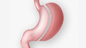 can you have gastric sleeve surgery twice