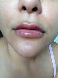 after juvederm lip injections