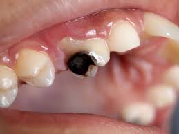 rotten teeth treating tooth decay
