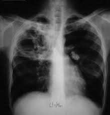 Pediatric Tuberculosis Overview Of Tuberculosis Tb Risk