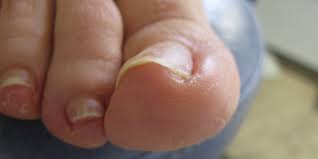 ingrown toenails diagnosis and what