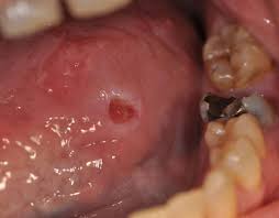 a traumatic ulcer adjacent to a