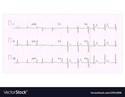 Heart Cardiogram Chart Of