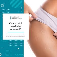 can stretch marks be removed
