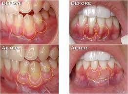 gum graft surgery in gilbert az