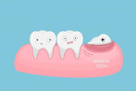 Severely impacted wisdom teeth require a longer healing time after removal. Five Benefits Of Removing Your Wisdom Teeth Naenae Dental Clinic