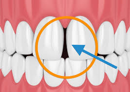 It's also common for our teeth to shift as we get older and when wisdom teeth come through. I Have A Broken Permanent Retainer Now What Premier Orthodontics