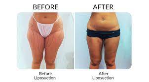 liposuction before and after gallery