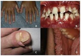 mucosa and nails in genodermatoses