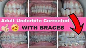 Both clear aligners and braces were effective in treating malocclusion, including an underbite. No More Underbite Adult Underbite Corrected With Braces And M E A W Technique Wires Youtube