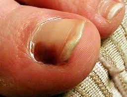 black area on big toenail melanoma or