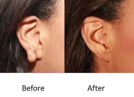 keloid scars in the woodlands tx dr