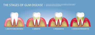 gum disease 牙龈疾病