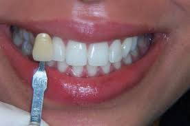 Who Wants A B1 Tooth Shade Blue Court Dental Centre Harrow