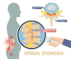 spinal stenosis what are the non