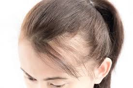 When trying to decide which hairstyle would go best with your receding hairline a barber or hair stylist will look at how your face, the shape of your head, whether it's oblong, round etc. Female Hair Loss Men S Health Atlanta