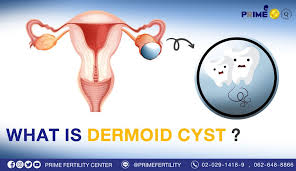 bangkok ivf what is dermoid cyst