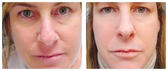 laser skin tightening in texas fab