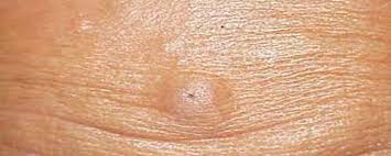 skin lesions lipoma sebaceous cyst
