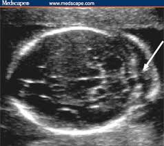Ultrasonographic Soft Markers Of Aneuploidy In Second Trimester
