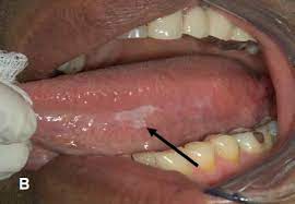 In this article we will explain in details how the early stage skin cancer looks like. Premalignant Oral Lesions