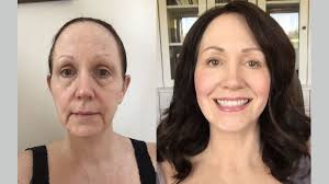 If you were to superimpose two ys over. The Renuvion J Plasma System Could It Revolutionize Or Replace The Facelift Or Neck Lift Lookyounger News