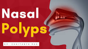 best nasal polyps treatment in