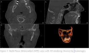3d imaging of the upper airway with
