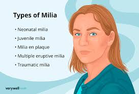 what do milia look like and how are