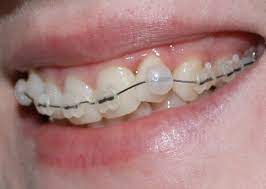 Wax alternatives may not naturally stick to braces in the same way as orthodontic wax. Do You Need To Put Wax On Teeth Braces For The First Few Days You Put Them On Quora