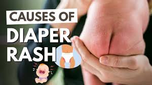 baby has diaper rash this is what