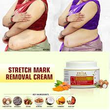 stretch mark removal cream