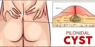 home remes for pilonidal cyst