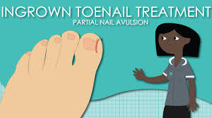 ingrown toenail treatment partial nail