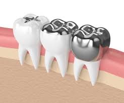Cavity fill cost with insurance When Do Dentists Use Porcelain Fillings Instead Of Silver Fillings