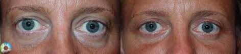 How can i get the samples9 a: Eyelid Surgery Blepharoplasty In Denver Co The Center For Cosmetic Surgery